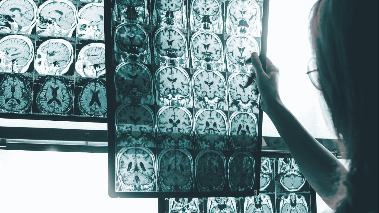 Así se desequilibra el cerebro con el Alzheimer: un índice permite medir el avance de la enfermedad